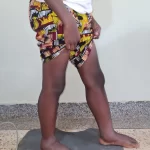 edema-support-foundation-gallery10