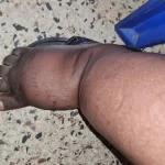 edema-support-foundation-gallery12