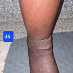 edema-support-foundation-gallery14