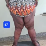edema-support-foundation-gallery15