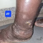 edema-support-foundation-gallery17