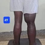 edema-support-foundation-gallery18