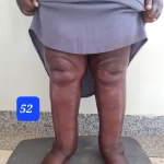 edema-support-foundation-gallery19