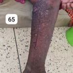edema-support-foundation-gallery21
