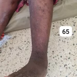edema-support-foundation-gallery22