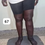 edema-support-foundation-gallery23