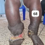 edema-support-foundation-gallery25