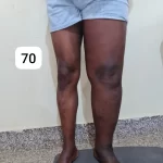 edema-support-foundation-gallery26