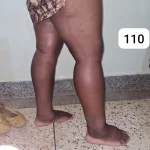 edema-support-foundation-gallery30