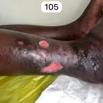 edema-support-foundation-gallery31