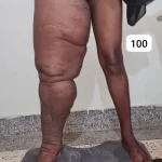 edema-support-foundation-gallery32