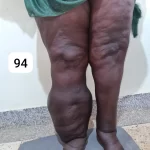 edema-support-foundation-gallery33