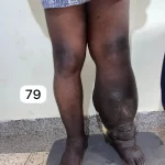 edema-support-foundation-gallery34
