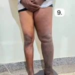 edema-support-foundation-gallery35