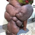edema-support-foundation-gallery36