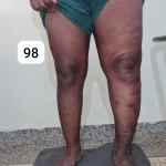edema-support-foundation-gallery37