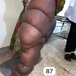edema-support-foundation-gallery38