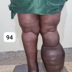 edema-support-foundation-gallery39