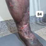 edema-support-foundation-gallery40