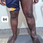 edema-support-foundation-gallery41