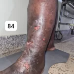 edema-support-foundation-gallery42