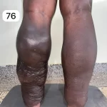edema-support-foundation-gallery44