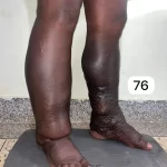 edema-support-foundation-gallery45