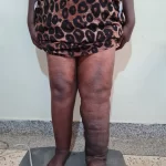 edema-support-foundation-gallery6