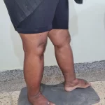 edema-support-foundation-gallery7