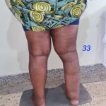 edema-support-foundation-gallery9