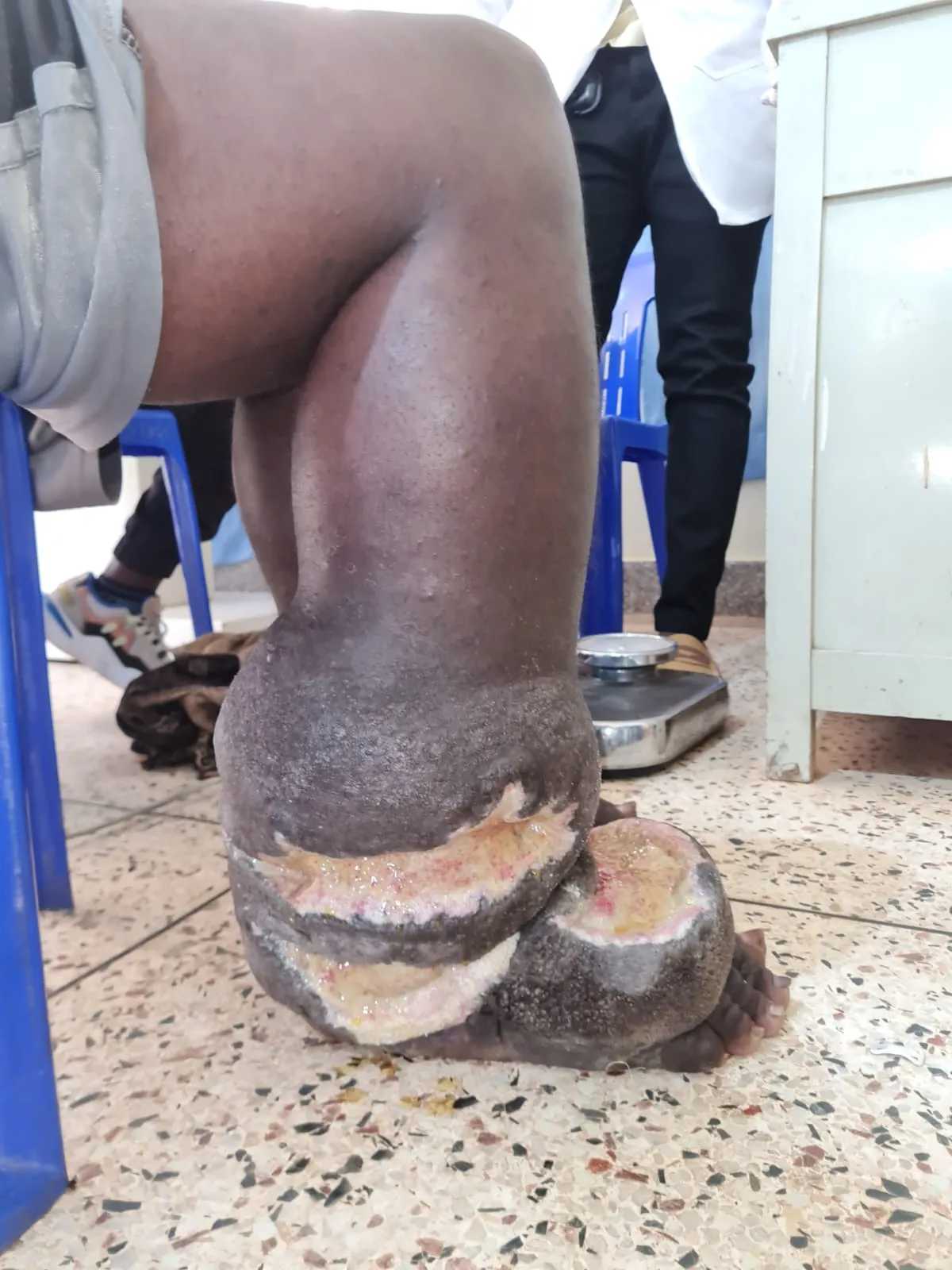 edema-support-foundation-images2