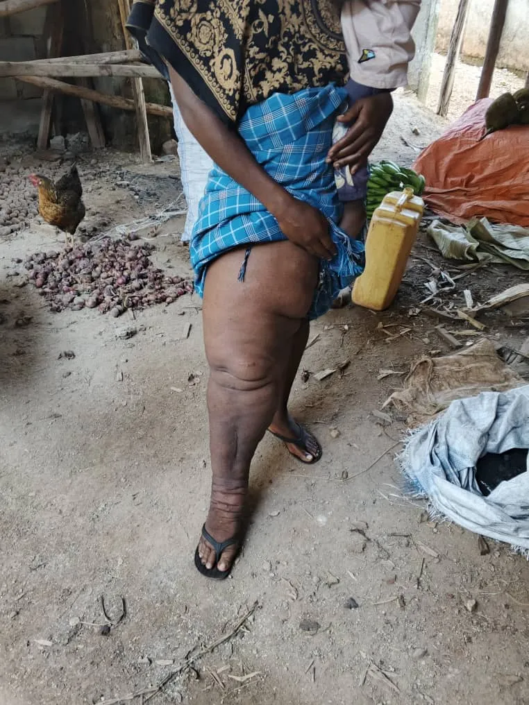 edema-support-foundation-images5