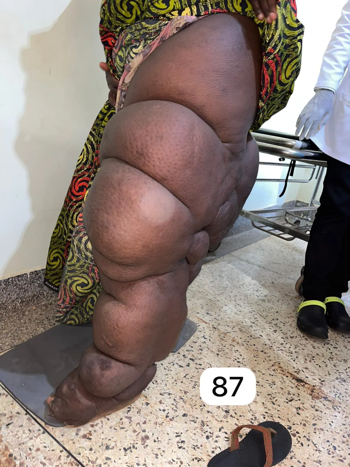edema-support-foundation-images6