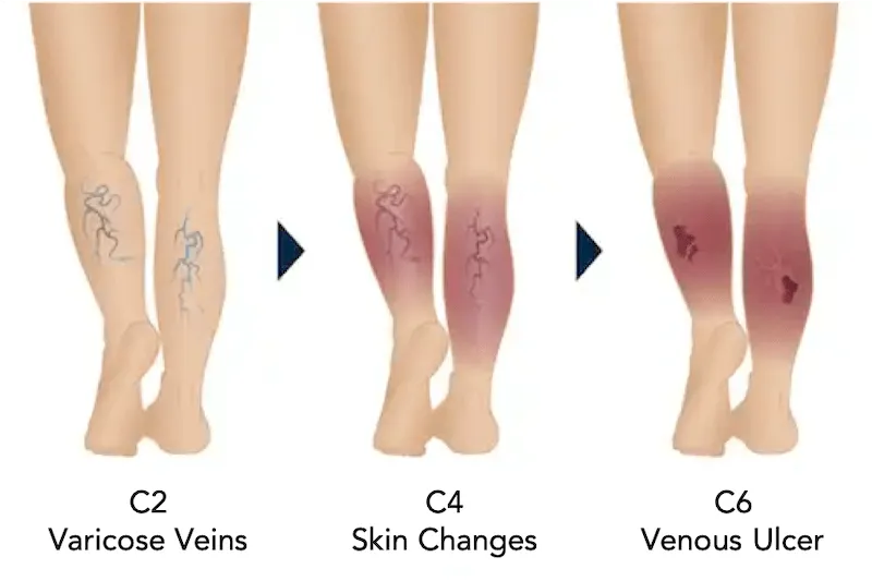 edema-support-foundation-images85