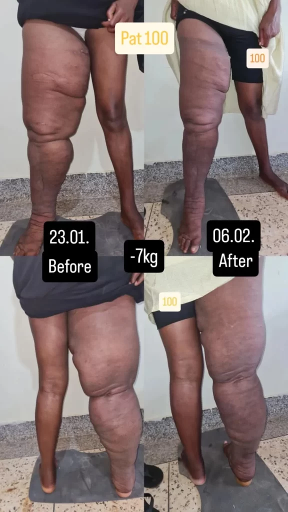 edema-support-foundation-patient-1001