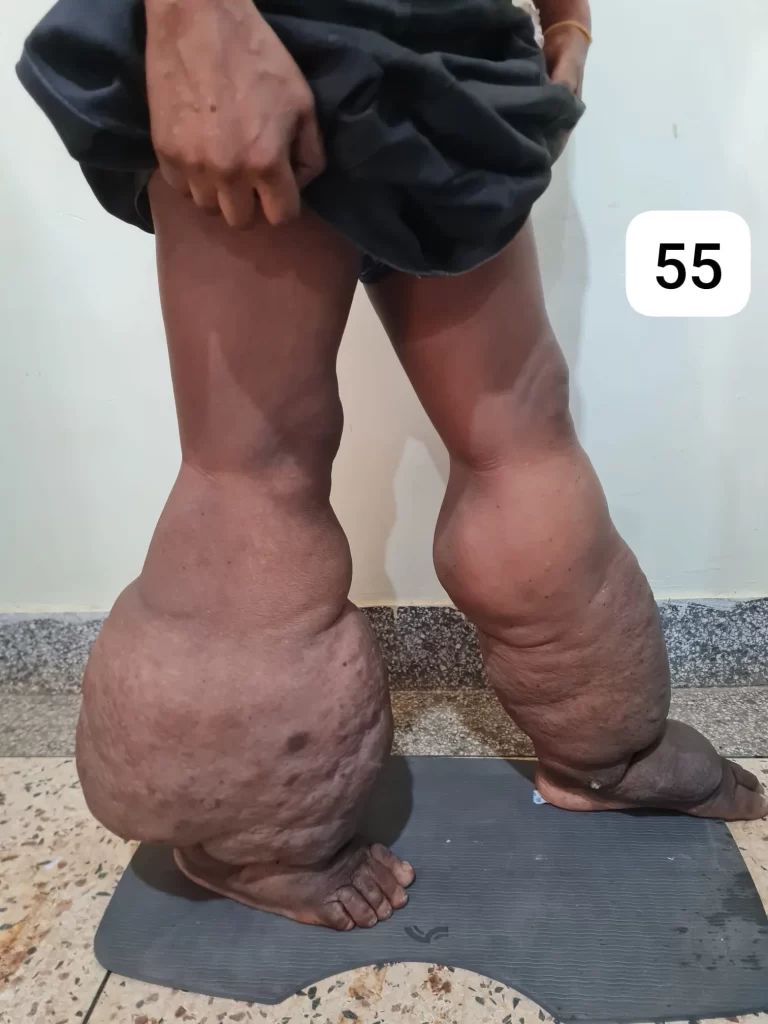 edema-support-foundation-patient-559